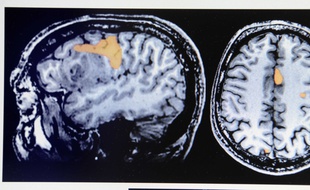 Images d'IRM d'un cerveau.