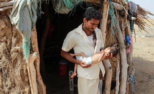 Un enfant souffrant de malnutrition.