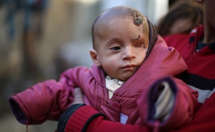 Karim Abdallah, un nourrisson syrien, a perdu son oeil gauche lors d'un raid aérien visant son quartier de la Ghouta, zone assiégée par le régime de Bachar al-Assad.