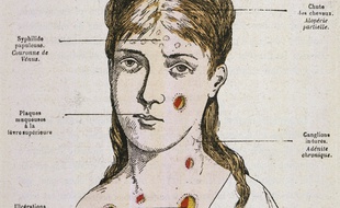 Les symptômes de la syphilis, décrits en 1883.