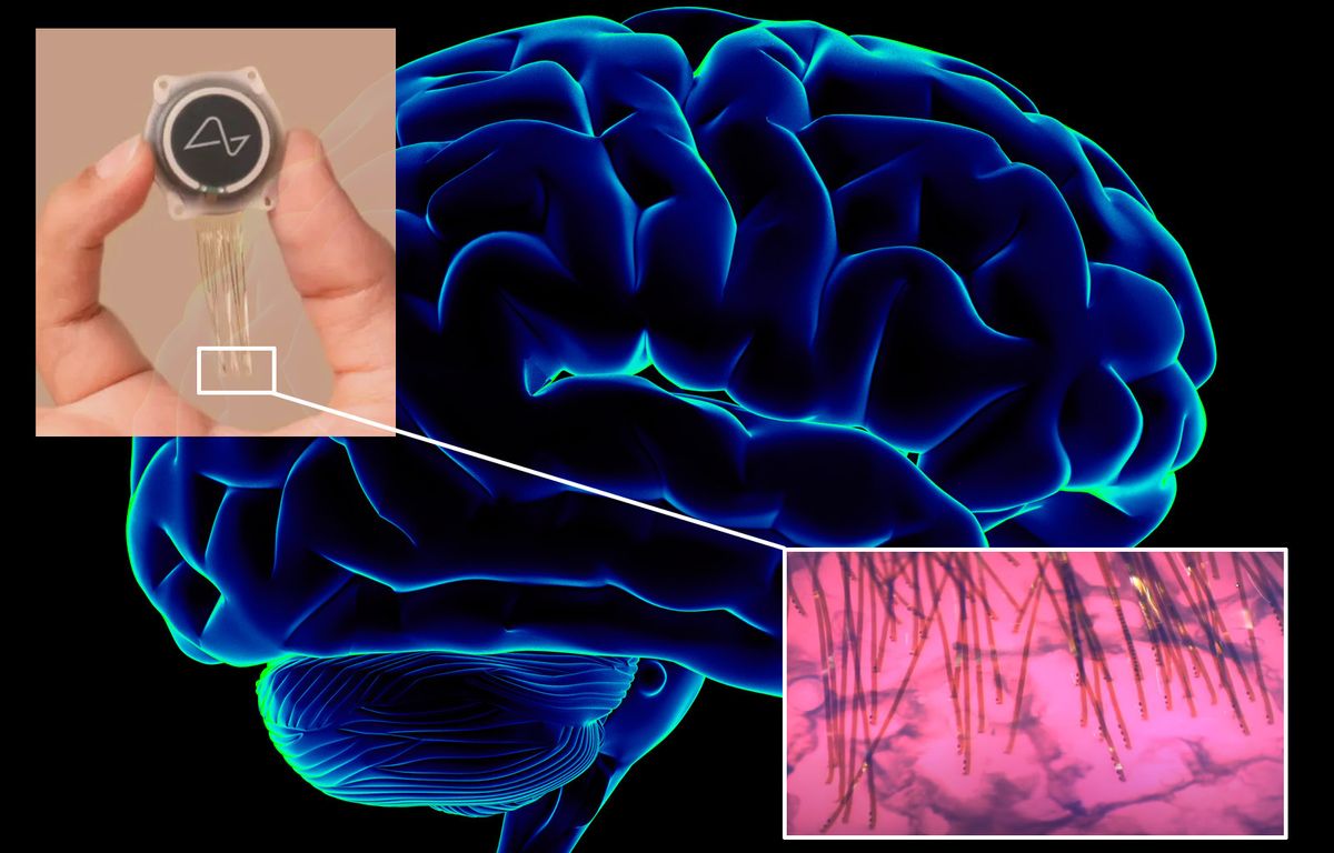 L'implant cérébral de Neuralink est encore loin de nous changer en cyborgs