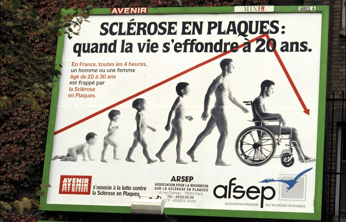 Sclérose en plaques Une chimiothérapie agressive peut contenir la