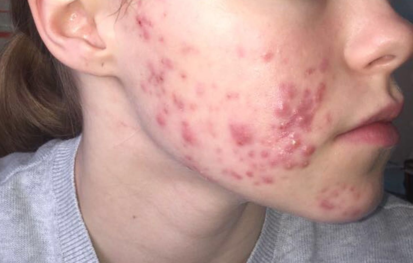 Acné sévère sur le visage d'une jeune femme de 19 ans.