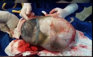 Au Brésil, un bébé est né dans son sac amniotique intact le 2 août 2016.