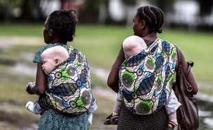 Les Albinos, notamment au Mali ou ici en Tanzanie, sont victimes de nombreuses discriminations en Afrique.