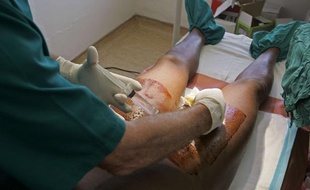 Photo illustrant une circoncision pratiquee sur un adulte au Swaziland en 2008.