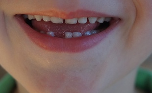 Conserver les dents de lait de vos enfants pourrait s'avérer précieux pour leur santé.