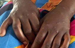 Plus de 5.000 cas de Mpox et 46 décès recensés en Sierra Leone