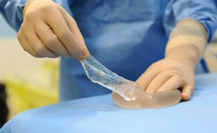 Une prothèse mammaire PIP retirée d'une patiente après que la membrane extérieure de l'implant s'est rompue.