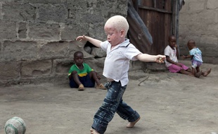 Yusufu, enfant albinos, a Dar es Salam, en Tanzanie, en 2010.