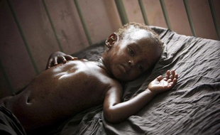 Un enfant déshydraté et malnutri dans un hôpital de Mogadiscio, en Somalie, en août 2011.
