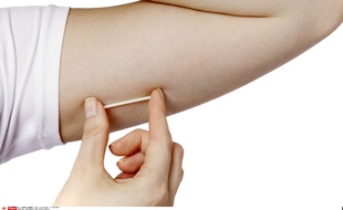 Illustration d'un implant contraceptif dans au niveau du bras (photo d'illustration).