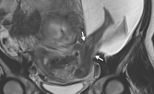 Un bébé sort ses jambes de l'utérus de sa mère
