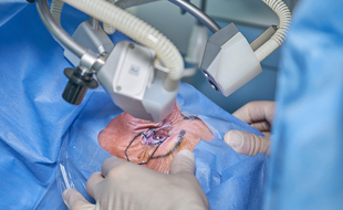 Illustration d'une opération de chirurgie réfractive.