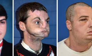 Richard Norris, avant et après son accident en 1997, puis après sa greffe du visage en 2012.