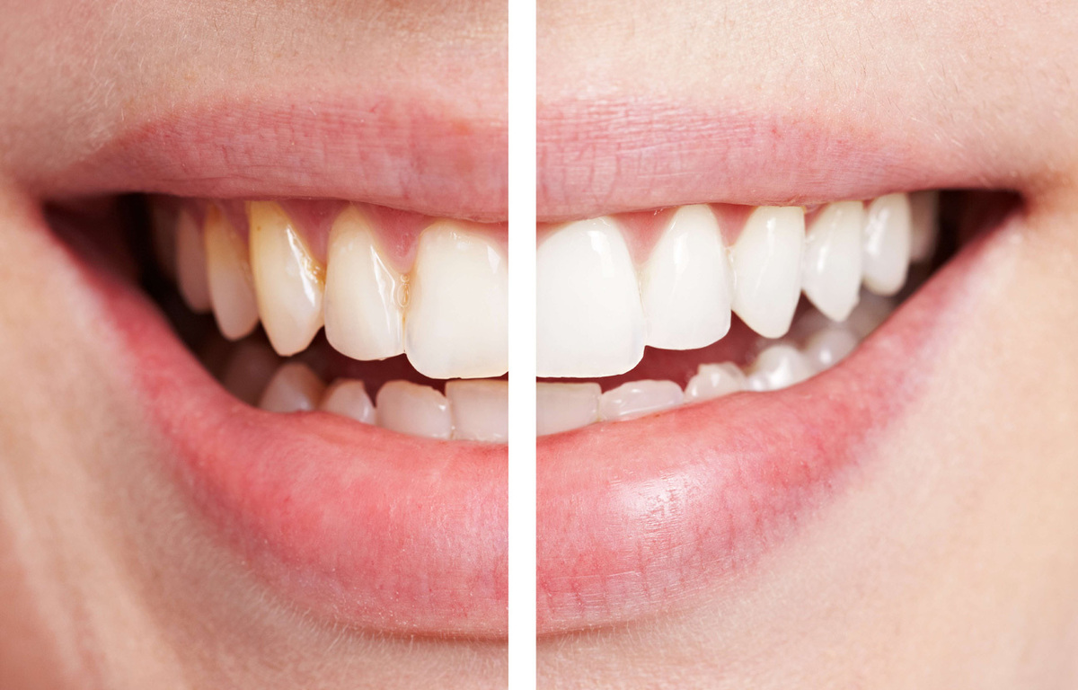 Blanchiment des dents avec gouttière (dents jaunes) à Paris, Technique et  prix