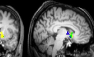 Clichés IRM montrant les zones du cerveau activées lorsque le sujet envisage de reverser une fraction de ses gains (donation ou taxe).