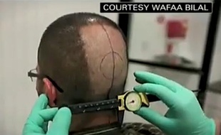 Capture d'écran d'un reportage de CNN sur Wafaa Bilal, qui s'est fait greffer une caméra derrière la tête.