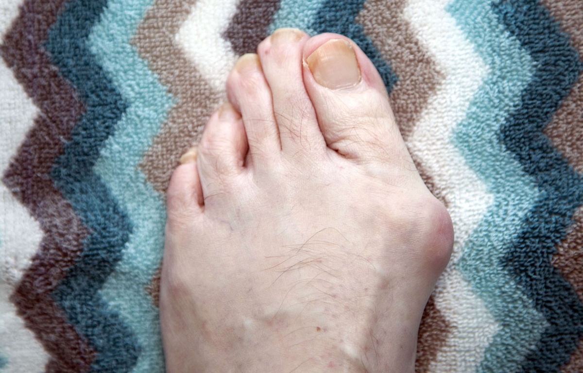 Oignon, pied tordu Comment soigner un hallux valgus?