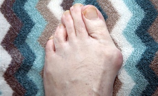L'hallux valgus peut entraîner une déformation douloureuse du pied.