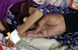 La malnutrition crée une forme nouvelle de diabète, selon des chercheurs