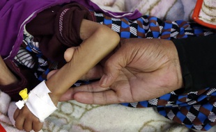 Un enfant souffrant de malnutrition au Yemen, le 19 mai 2019.