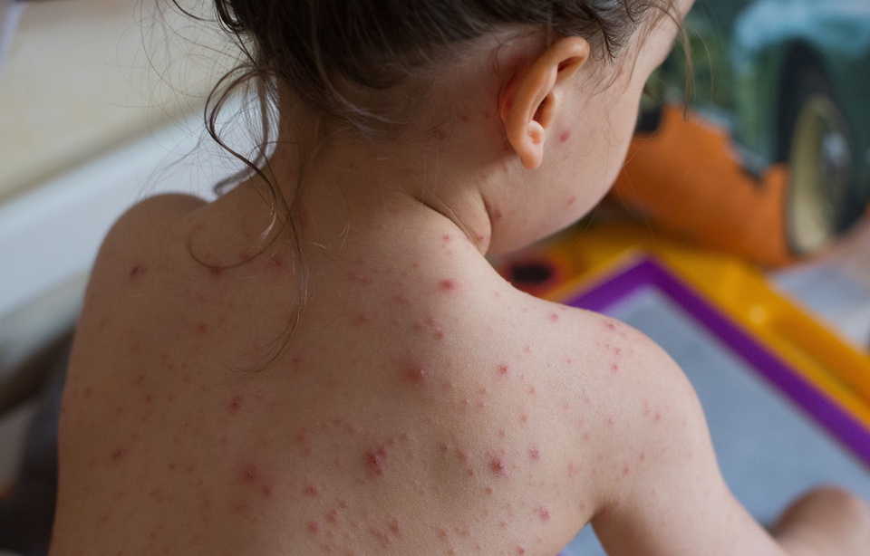 960x614_petite-fille-touchee-virus-varic