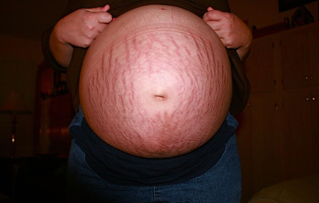 Is it a good idea to “hide” pregnancy stretch marks with a tattoo?