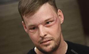 L'Américain Andy Sandness a reçu une greffe totale du visage à la Mayo Clinic de Rochester dans le Minnesota (Etats-Unis) le 24 janvier 2017.