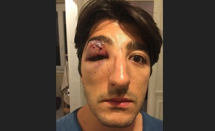 Arnaud Gagnoud a été agressé à Paris alors qu'il se trouvait avec son compagnon. La photo a été prise le lendemain de l'agression.