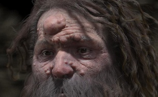 Le célèbre homme de Cro-Magnon avait le visage couvert de nodules