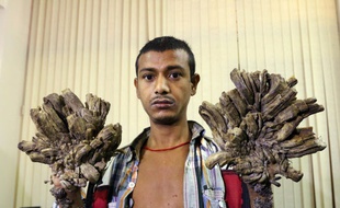 Âgé de 27 ans, Abul est incapable de travailler depuis des années à cause de sa maladie.