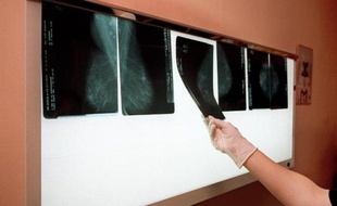 Un médecin examine les radios du sein d'une patiente afin de détecter un éventuel cancer