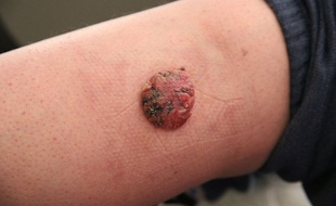 Illustration d'un cancer de la peau.
