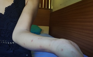 Une résidente de la Cité universitaire de l'Arsenal, à Toulouse, a été victime de punaises de lit.