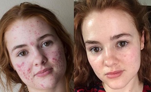 Kali Kushner, une Américaine de 22 ans, dévoile sur Instagram son combat contre l'acné.