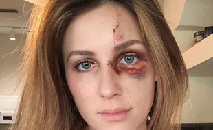 Melissa Gentz a décidé de dénoncer les violences de son compagnon en postant une photo de son visage sur Instagram.