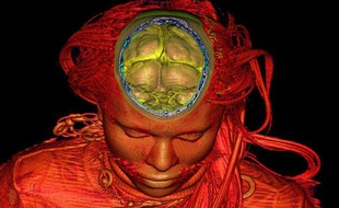 Le cerveau et l'intérieur d'un crane visualisés grâce à l'imagerie par résonnance magnétique.