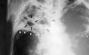 Une radio des poumons d'un patient atteint de tuberculose