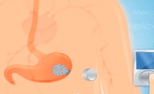 Une puce est censée émettre une stimulation électronique de l'appareil digestif afin de dissiper la sensation de faim.