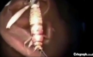 Un Indien s'est fait retirer un criquet vivant de l'oreille.