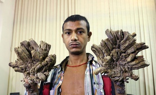 Abul Bajandar, surnommé "l'homme-arbre", va subir une opération pour être débarrassé des excroissances provoquées par sa maladie génétique rarissime.