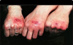 Les blessures occasionnées par la Painstation.