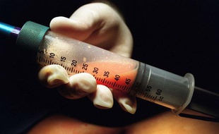 De la graisse humaine obtenue par liposuccion.