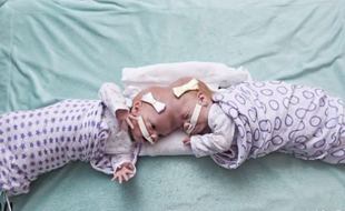 Erin et Abby Delaney ont été séparées le 7 juin dernier après une opération de 11 heures.