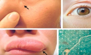 Une Russe a découvert qu'un ver se promenait sous la peau de son visage.
