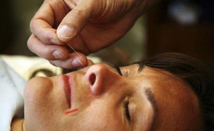 Photo d'illustration sur l'acupuncture.