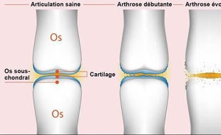 Des implants d'une nouvelle génération pour réparer le cartilage mis au point à Strasbourg