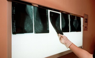 Jusqu'alors, seules les femmes entre 50 et 74 ans avaient droit à une mammographie remboursée à 100% tous les deux ans