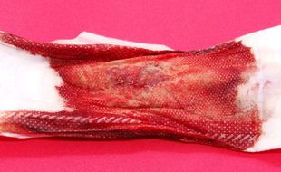 Hémorragies de privation sur une serviette hygiénique à ailettes.